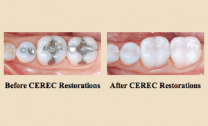 Cerec Before And After Photo