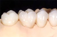 Chicago Porcelain Crowns, Bridges, Onlays, Inlays