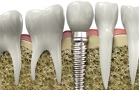 Chicago Dental Implants