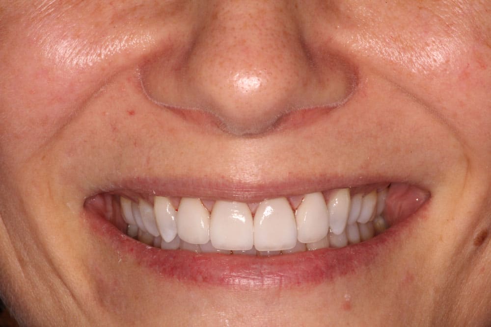 Veneers After Day Of Delivery Photo