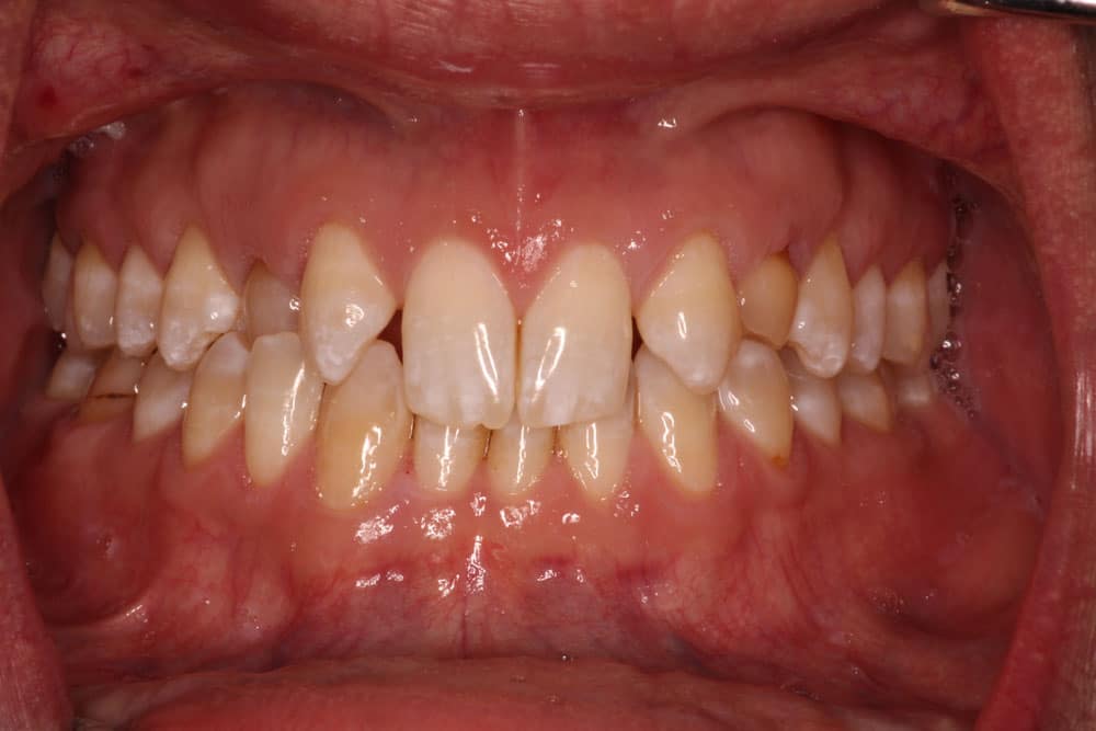 Congenitally Missing Teeth - Before Treatment Photo