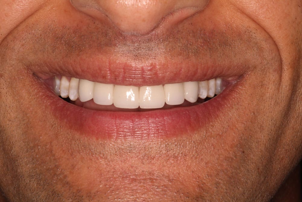 Congenitally Missing Teeth - After Treatment Photo