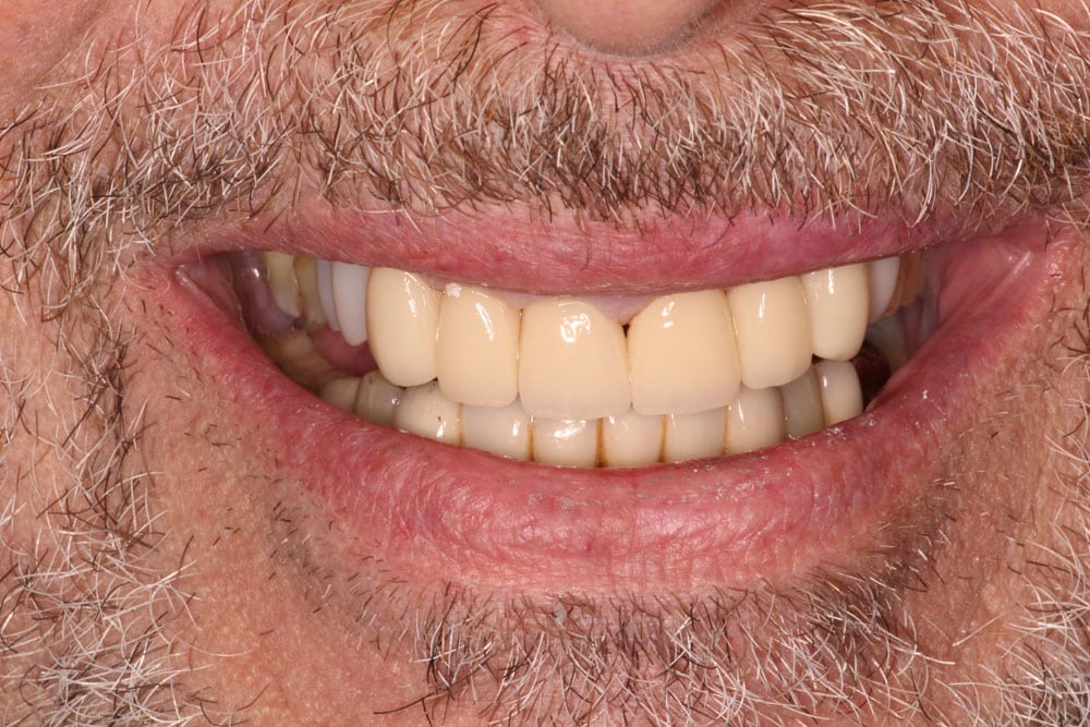 Crowns - After Treatment Photo