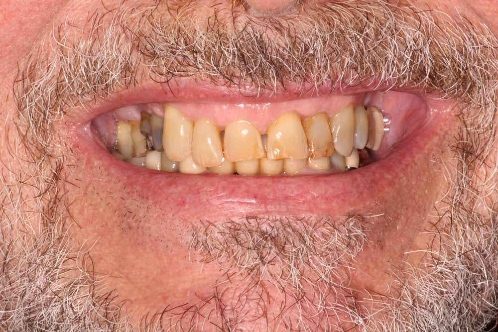 Crowns - Before Treatment Photo