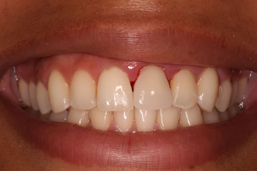 Aesthetic Emergency - Same Day Crown- After Treatment Photo
