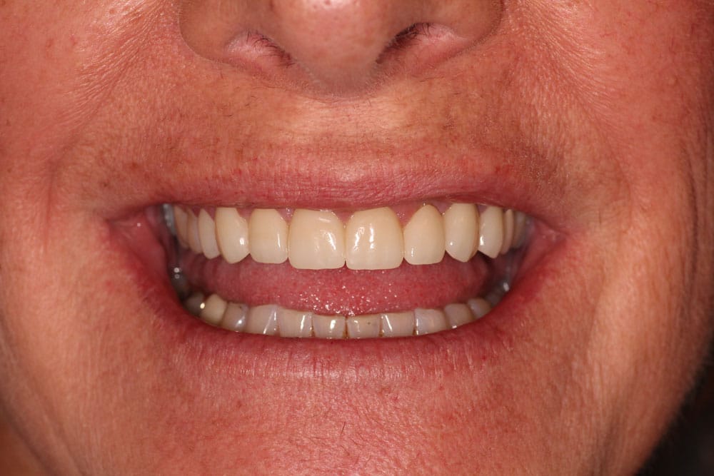 Full Arch Crowns - After Treatment Photo