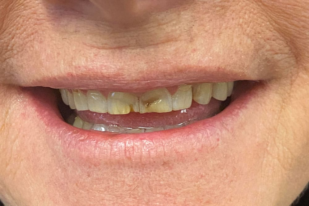 Full Arch Crowns - Before Treatment Photo