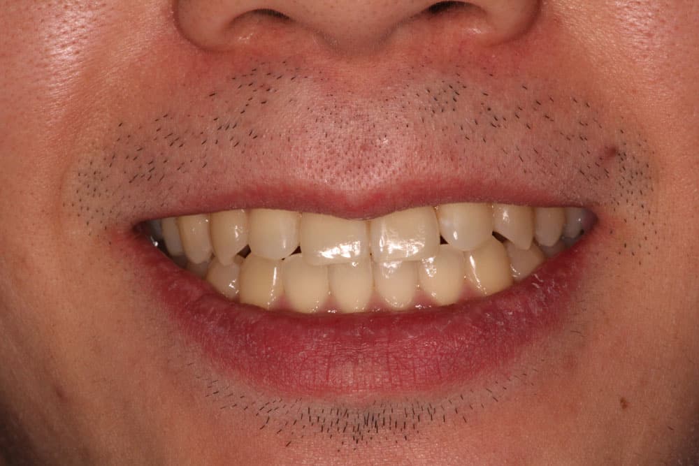Invisalign- After Treatment Photo