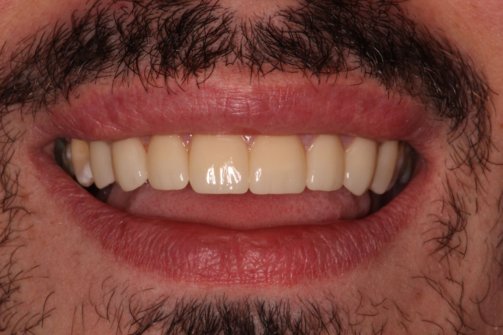 Rampant Caries - After Treatment Photo