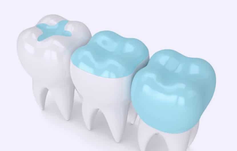 Reducing Risk Of Cavities With Dental Sealants