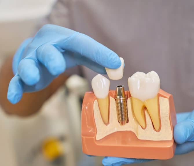 Dental Implants In Chicago