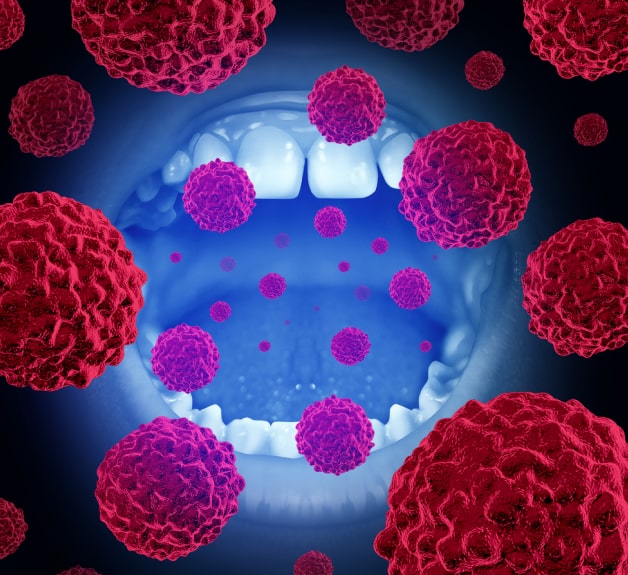 Oral Cancer Screening In Chicago