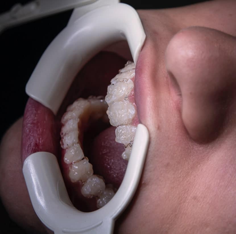 Teeth Whitening In Chicago, IL