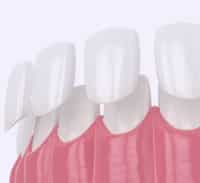 Dental Veneers Chicago