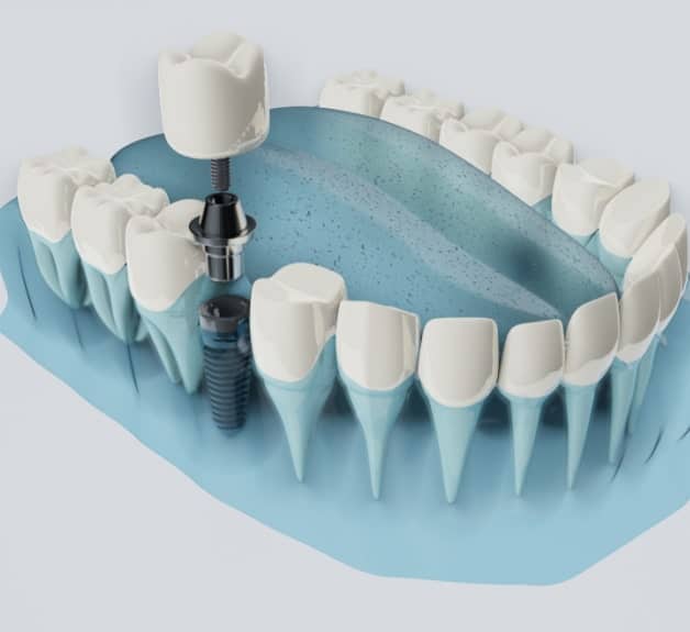 All On X Dental Implants In Chicago, IL