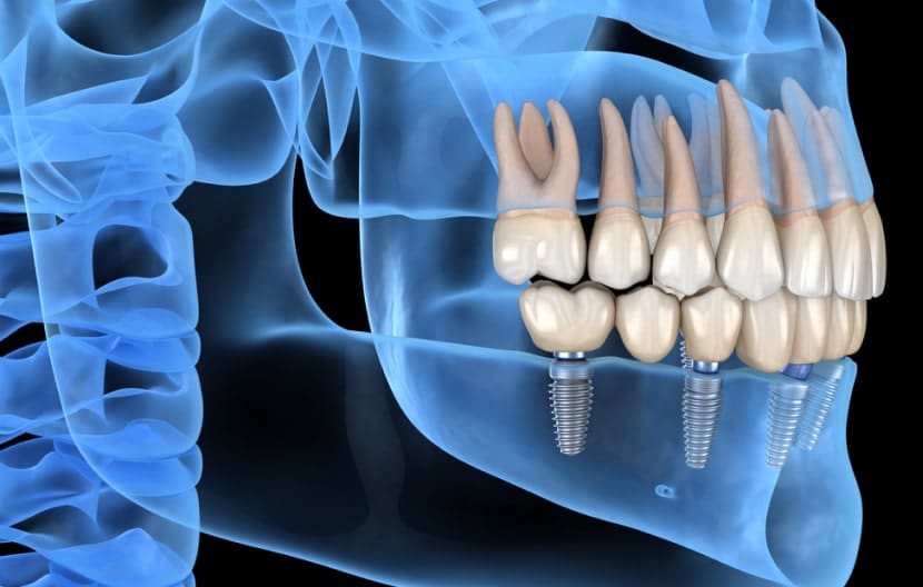 All On X Dental Implants
