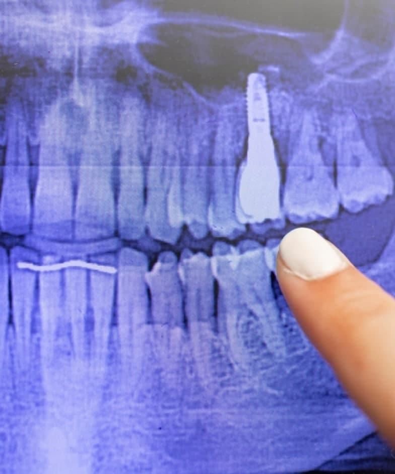 Factors that Affect The healing Period Of All-on-X Dental Implants