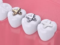 Dental Sealants Chicago